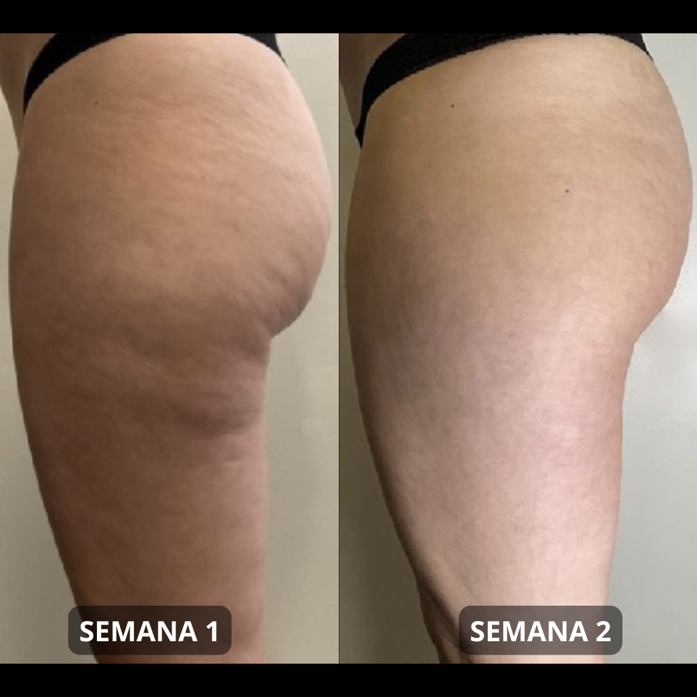 Parches Reafirmantes Anticelulitis